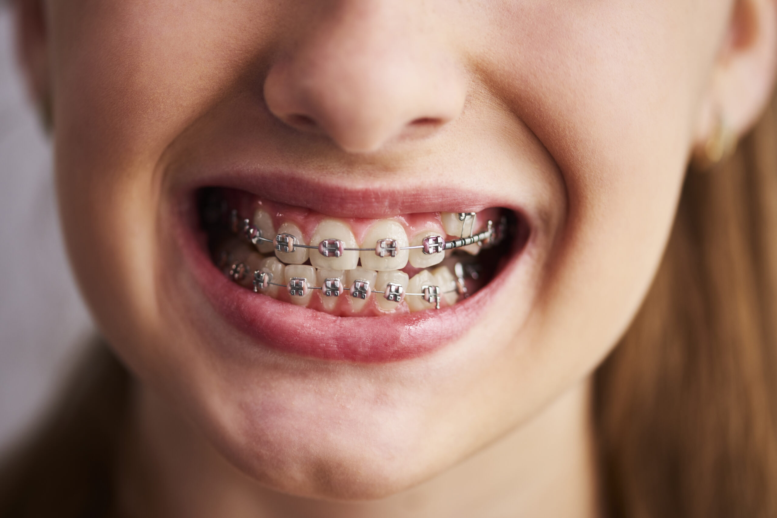 7 Tips Menjaga Gusi Sehat bagi Pemakai Behel
